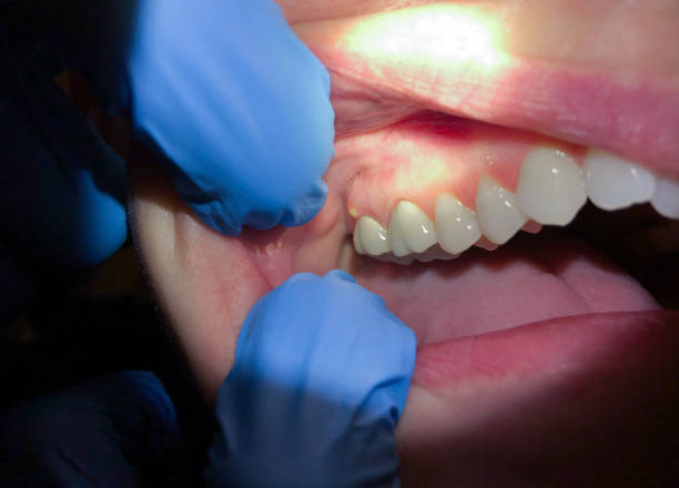 Best Emergency Dental Care for Broken or Chipped Teeth in Westport, IN