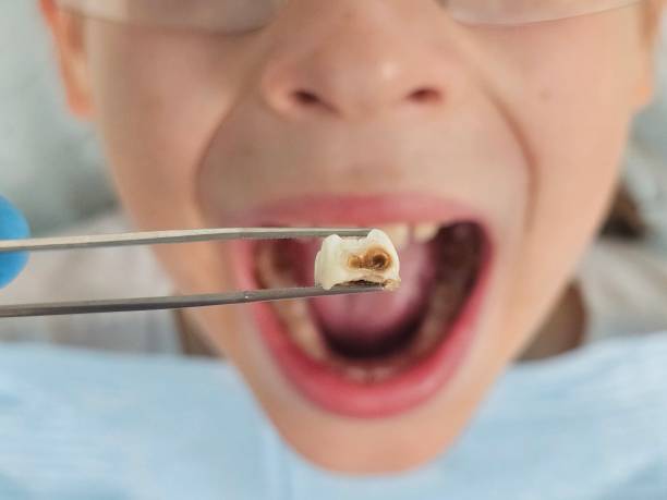 Best Emergency Tooth Extraction in Westport, IN